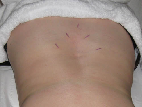 Lower back pain - acupuncture