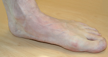 Flat feet