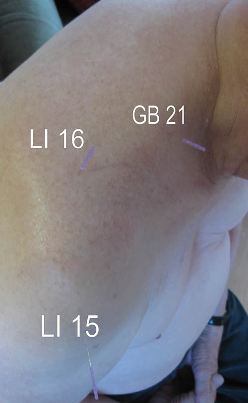 Shoulder pain - acupuncture